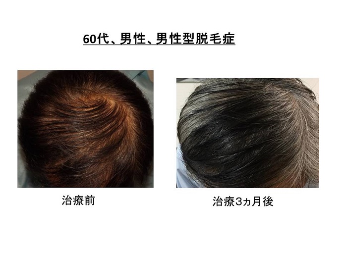 円形脱毛症　病院""